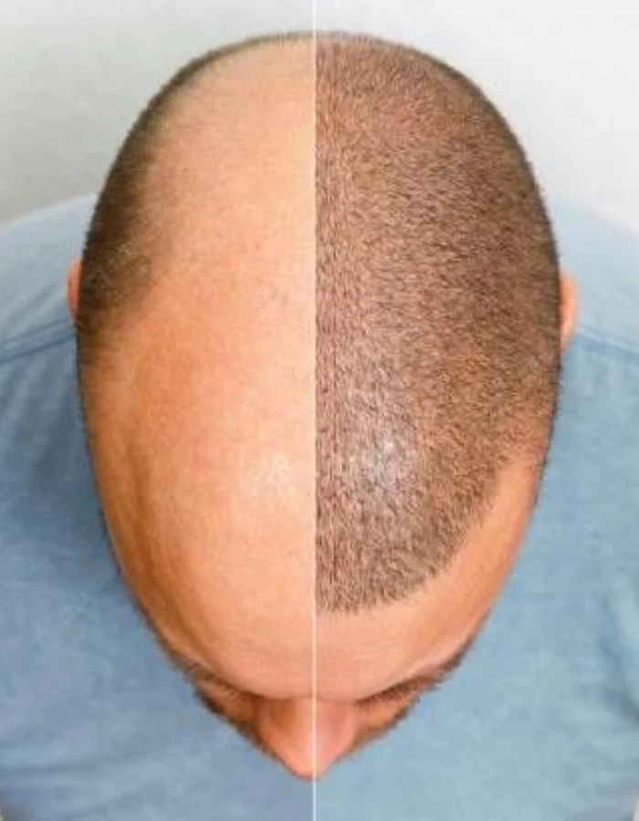 Existing Hair Density