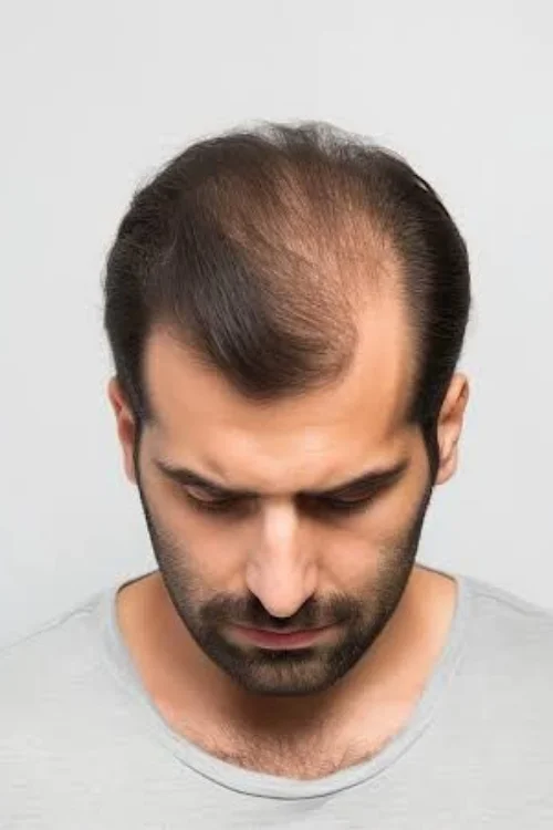 Understanding What Happens During Scalp Micropigmentation