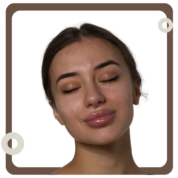 Acne Treatment